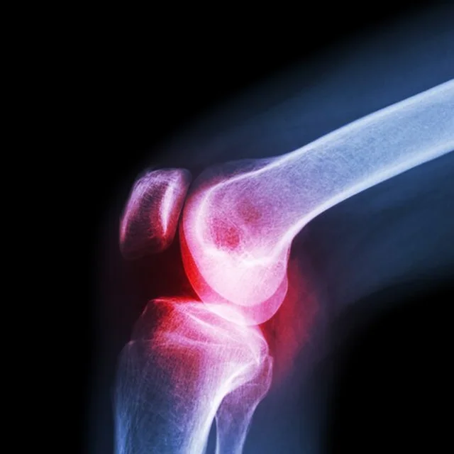 Knee Cap for Support – XL Breathable Joint Brace | Velvet Wellness