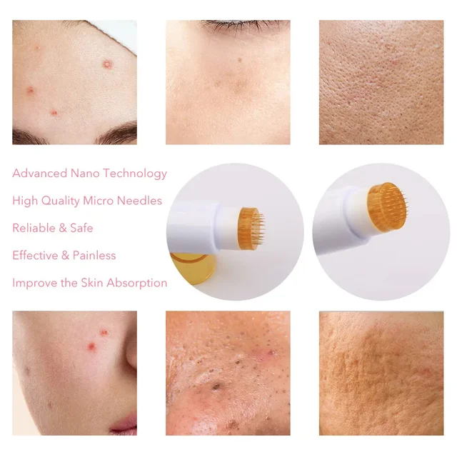 Derma Stamp 1.5 MM With Titanium Needles For Acne Scars, Wrinkles,Hair Regrowth - 1.5 mm, White
