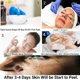 Aa Ultra Clean Peel For Tca Cross Marks Dark Spots, Hyper Pigmentation, Melasma etc