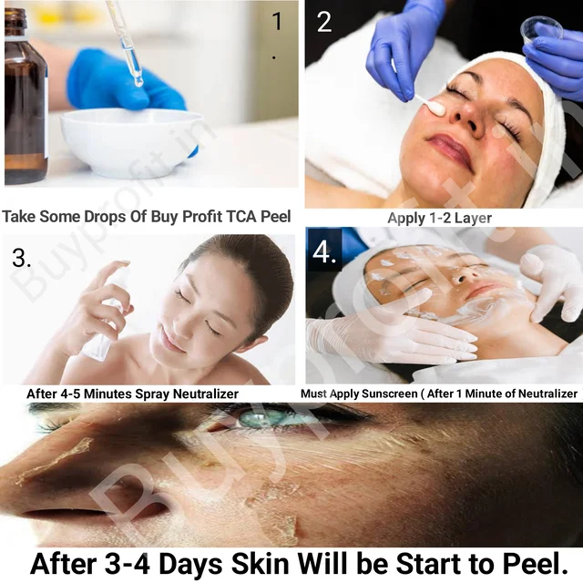 Aa Ultra Clean Peel For Tca Cross Marks Dark Spots, Hyper Pigmentation, Melasma etc