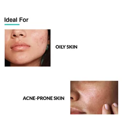 Fixderma 2% Salicylic Acid Serum 30g | With 5% Azelaic Acid & 4% Mandelic Acid | Anti-Acne & Spot Treatment | Controls Oil, Clears PoresFace Serum for Men & Women
