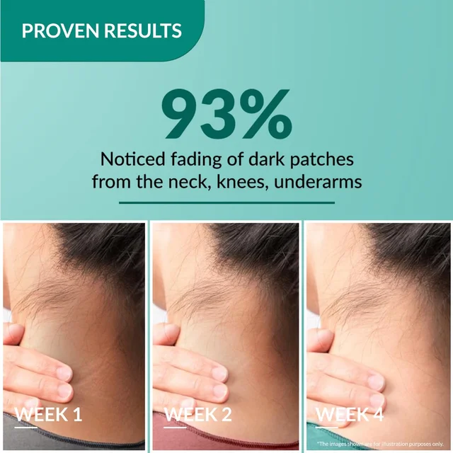 Fixderma Nigrifix Cream for Acanthosis Nigricans 50g | Exfoliating Cream with Lactic Acid & Retinol | Reduces Dark Thick Skin on Neck, Underarms, Knuckles, Elbows & More