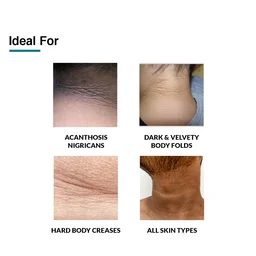 Fixderma Nigrifix Cream with retinol, Lactic Acid & Urea | For Skin Imperfection associated with Acanthosis Nigricans | For Body Parts like Neck, Ankles, Knuckles, Armpits & Elbows | For Dark & Dry Skin | Exfoliant Darkest Skin Gently | 100g