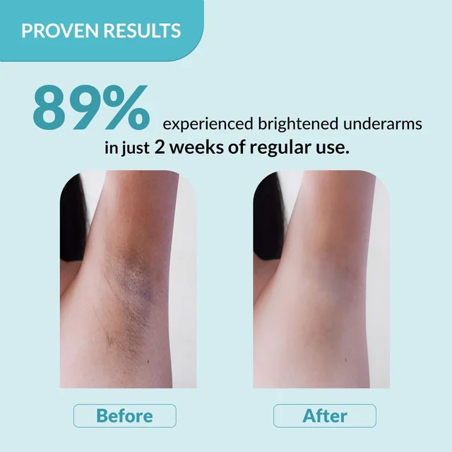 Fixderma Nigrifix Underarm Roll On 60ml with 6% AHA, Lactic Acid, 1% Mandelic Acid & Kojic Acid | Brightens, Exfoliates & Smoothens Dark UnderarmsFor All Skin Types