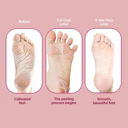 Furr by Pee Safe Peeling & Exfoliating Foot Mask for Unisex use| Glycolic & Salicylic Acid | Reduces Dry Skin & Hard Calluses | Moisturizes & Hydrates Feet | Nourishing Sock-Style Foot Mask