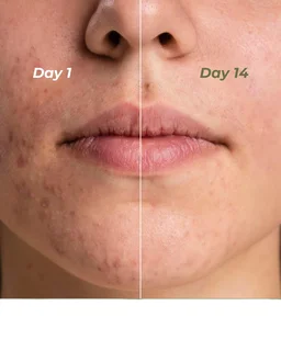 Indus Valley Calming Acne Gel 30ml with Seaweed Extract & Tea Tree Oil | Soothing Clarifying Gel for Pimples, Blemish-Prone Skin, Fresh & Clear-Looking Skin