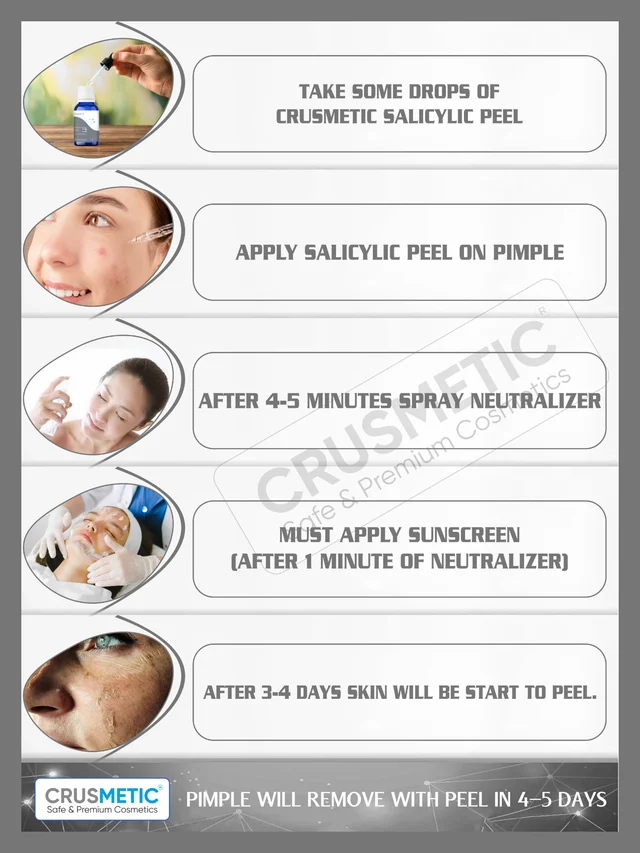Crusmetic Salicylic Peel 15% - Advanced Acne Treatment Formula