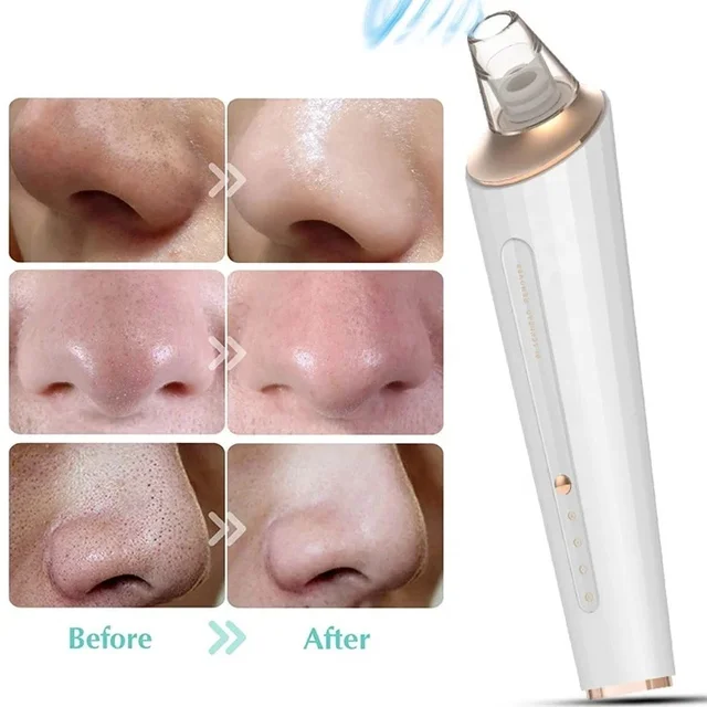 5 In 1 Multi-Function Blackhead Whitehead Extractor Remover Device Facial Cleansing Tool ,Skin Cleaner,Pimple Removal Tool,Acne Pimple Pore Cleaner Vacuum Suction Tool For Men & Women (5 in 1 Pro blackhead remover)